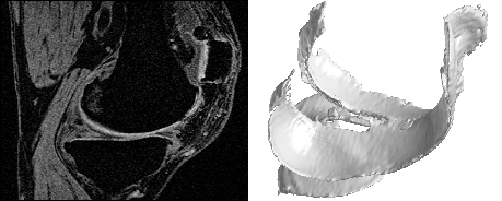 Automatic Segmentation of Bone and Cartilage in Knee MRI